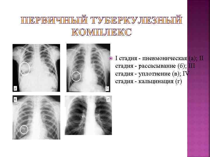  I стадия - пневмоническая (а); II стадия - рассасывание (б); III стадия -