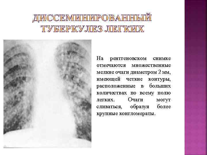 На рентгеновском снимке отмечаются множественные мелкие очаги диаметром 2 мм, имеющей четкие контуры, расположенные