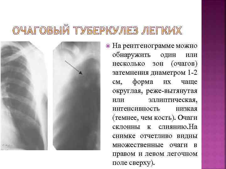  На рентгенограмме можно обнаружить один или несколько зон (очагов) затемнения диаметром 1 -2