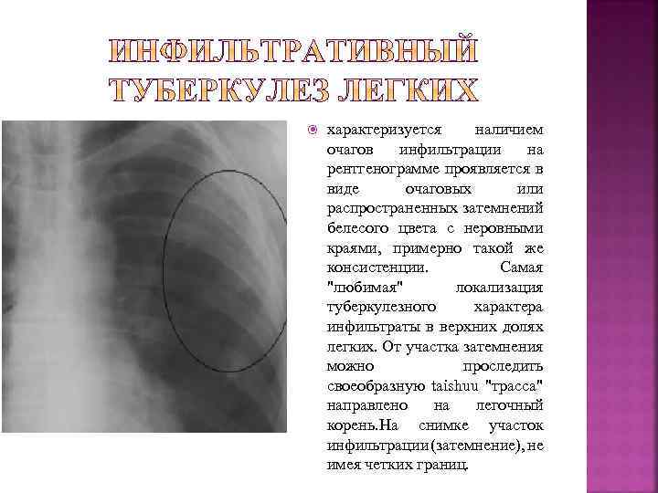  характеризуется наличием очагов инфильтрации на рентгенограмме проявляется в виде очаговых или распространенных затемнений