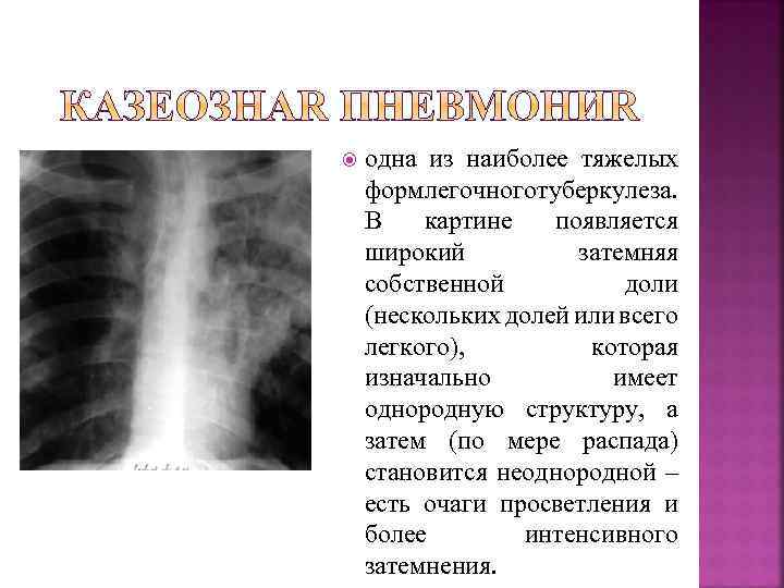  одна из наиболее тяжелых форм егочного уберкулеза. л т В картине появляется широкий