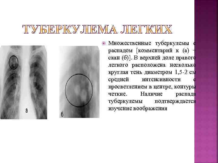  Множественные туберкулемы с распадом [комментарий к (а) + скан (б)]. В верхней доле