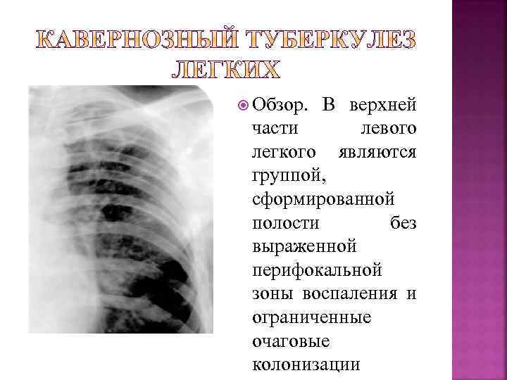  Обзор. В верхней части левого легкого являются группой, сформированной полости без выраженной перифокальной