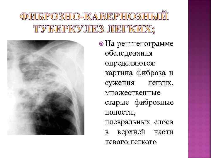  На рентгенограмме обследования определяются: картина фиброза и сужения легких, множественные старые фиброзные полости,