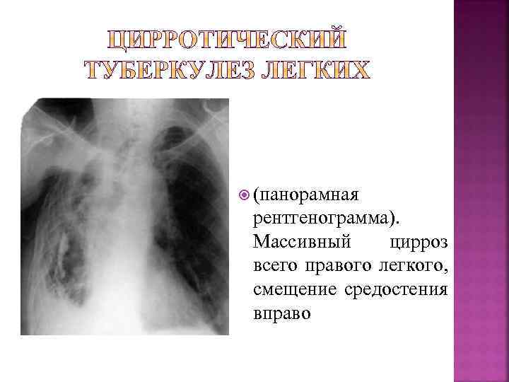  (панорамная рентгенограмма). Массивный цирроз всего правого легкого, смещение средостения вправо 
