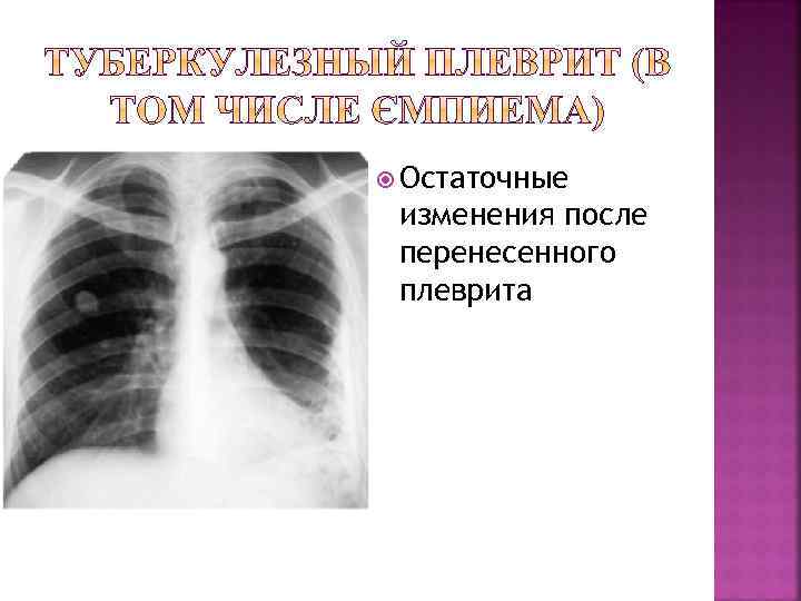  Остаточные изменения после перенесенного плеврита 