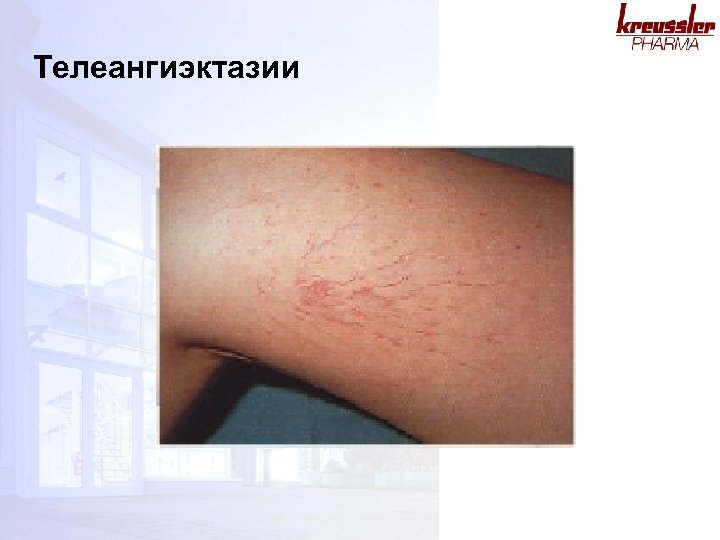 Телеангиэктазии 