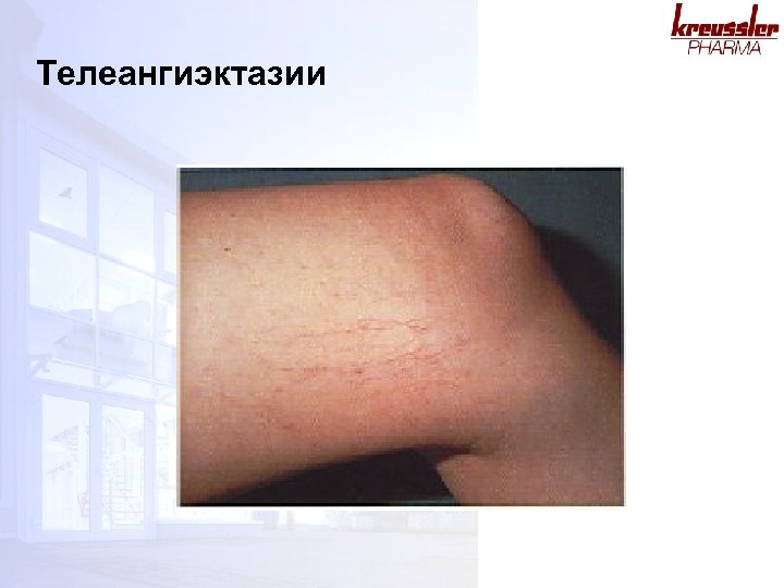 Телеангиэктазии 