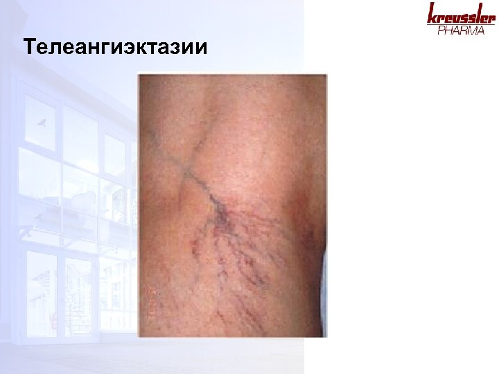 Телеангиэктазии 