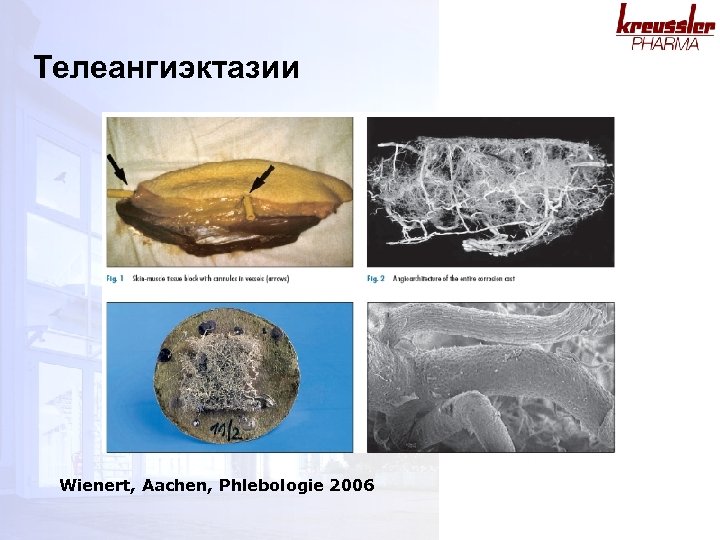 Телеангиэктазии Wienert, Aachen, Phlebologie 2006 