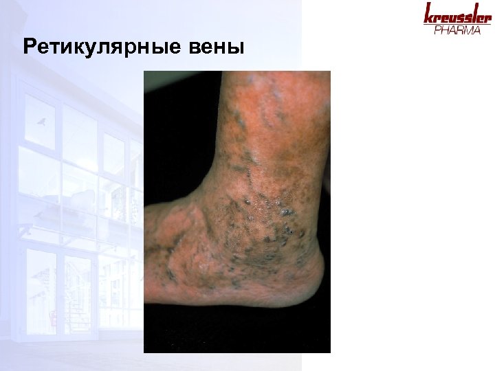 Ретикулярные вены 