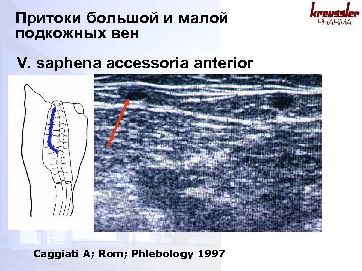 Притоки большой и малой подкожных вен V. saphena accessoria anterior Caggiati A; Rom; Phlebology