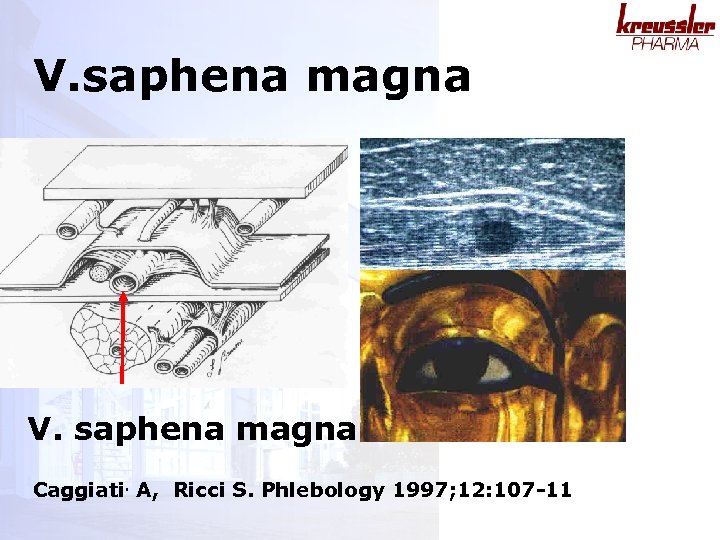 V. saphena magna Caggiati. A, Ricci S. Phlebology 1997; 12: 107 -11 