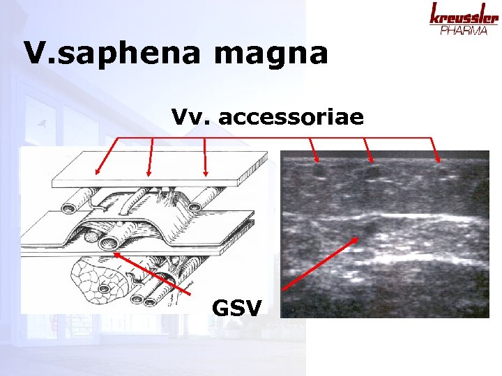 V. saphena magna Vv. accessoriae GSV 