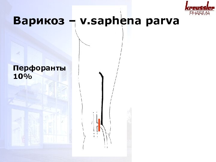Варикоз – v. saphena parva Перфоранты 10% 