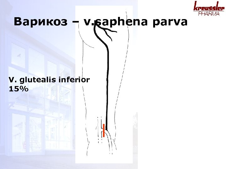 Варикоз – v. saphena parva V. glutealis inferior 15% 