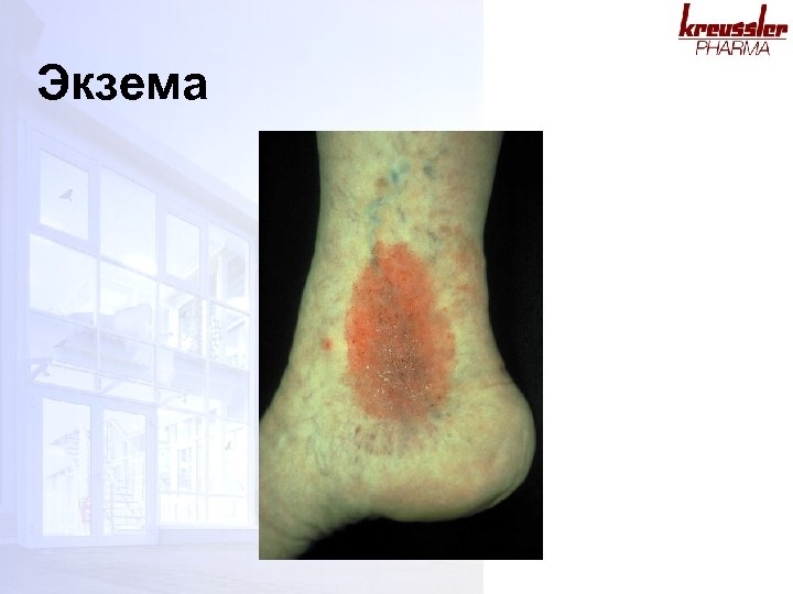 Экзема 