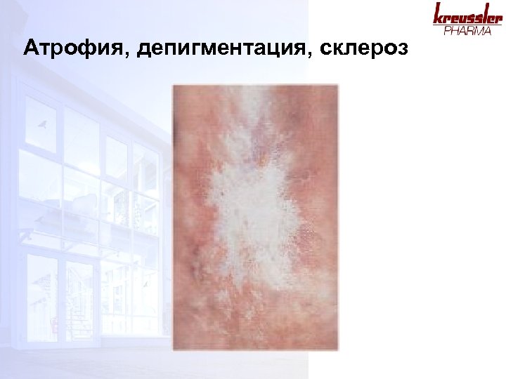 Атрофия, депигментация, склероз 