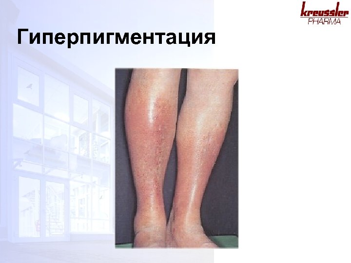Гиперпигментация 