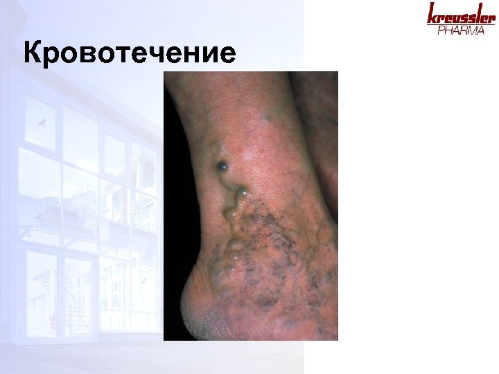 Кровотечение 