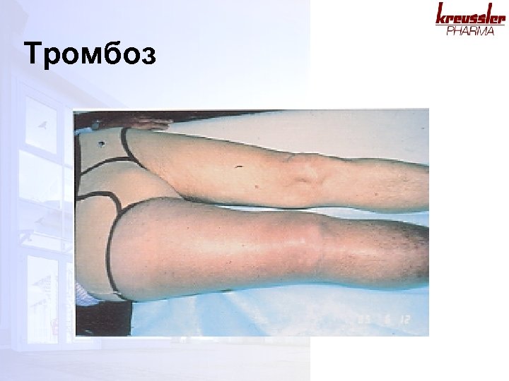 Тромбоз 
