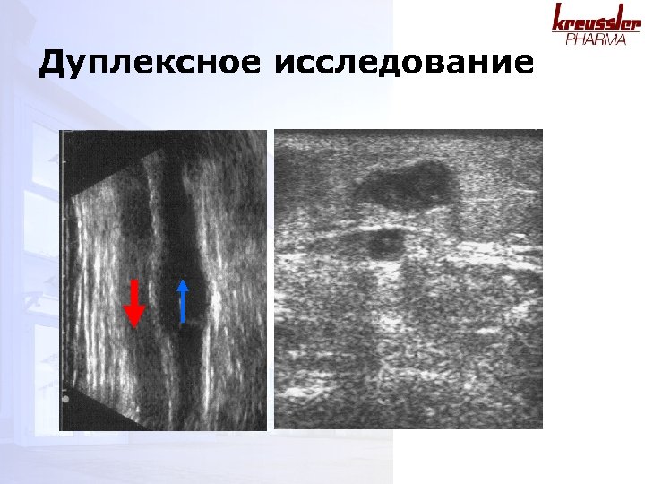 Дуплексное исследование 