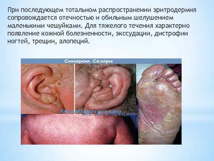 При последующем тотальном распространении эритродермия сопровождается отечностью и обильным шелушением маленькими чешуйками. Для тяжелого