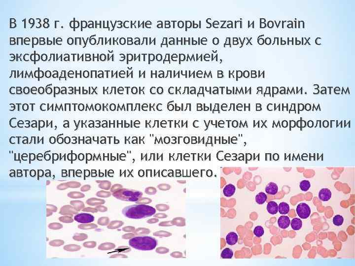 В 1938 г. французские авторы Sezari и Bovrain впервые опубликовали данные о двух больных