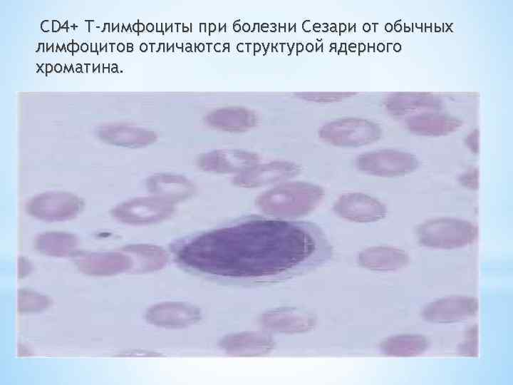 CD 4+ Т-лимфоциты при болезни Сезари от обычных лимфоцитов отличаются структурой ядерного хроматина. 