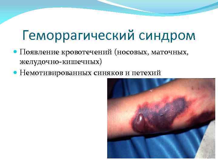 Геморрагический синдром Появление кровотечений (носовых, маточных, желудочно-кишечных) Немотивированных синяков и петехий 