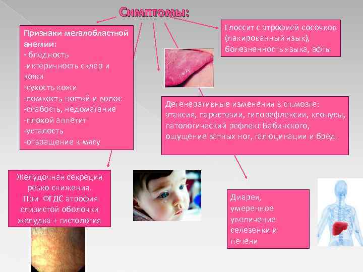 Симптомы: Признаки мегалобластной анемии: - бледность -иктеричность склер и кожи -сухость кожи -ломкость ногтей