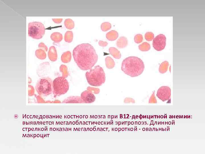  Исследование костного мозга при В 12 -дефицитной анемии: выявляется мегалобластический эритропоэз. Длинной стрелкой