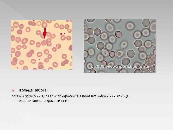  Кольца Кебота остатки оболочки ядра эритрокариоцита в виде восьмерки или кольца, окрашиваются в