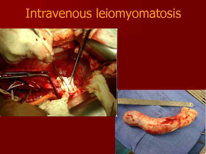 Intravenous leiomyomatosis 