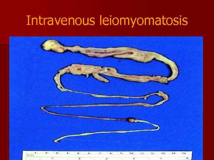 Intravenous leiomyomatosis 