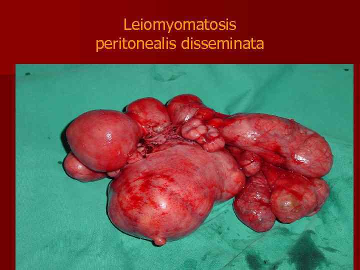 Leiomyomatosis peritonealis disseminata 