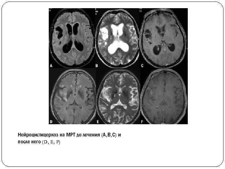 Нейроцистицеркоз на МРТ до лечения (А, В, С) и после него (D, E, F)