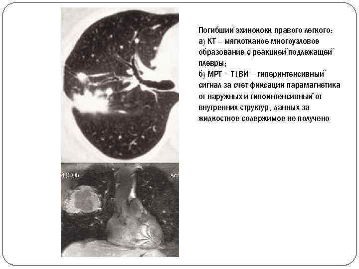 Погибшии эхинококк правого легкого: а) КТ – мягкотканое многоузловое образование с реакциеи подлежащеи плевры;