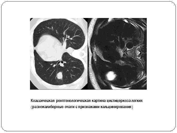 Классическая рентгенологическая картина цистицеркоза легких (разнокалиберные очаги с признаками кальцинирования) 