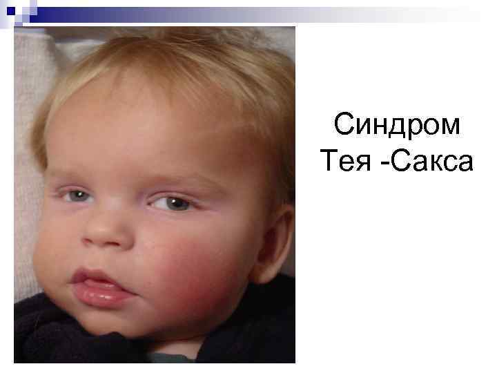 Болезнь тея сакса фото