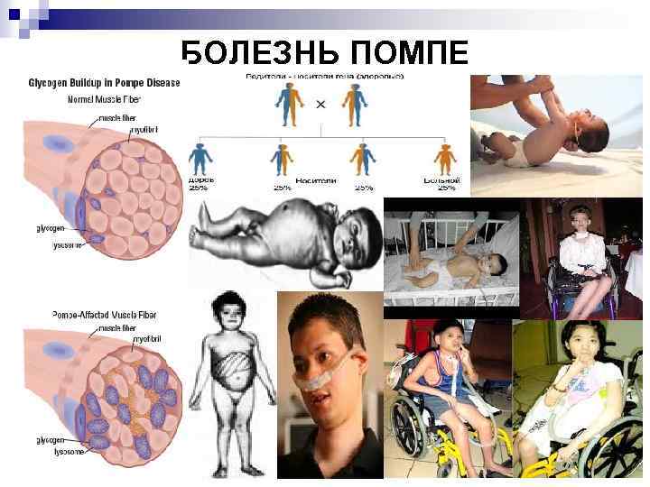 БОЛЕЗНЬ ПОМПЕ 