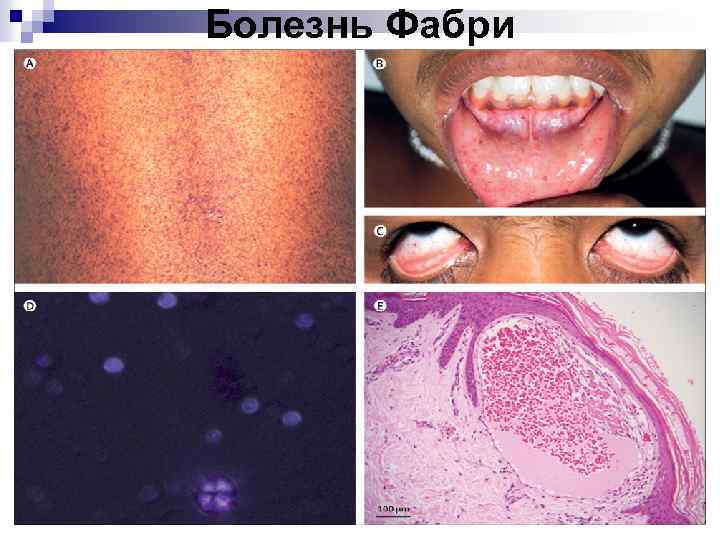 Болезнь Фабри 