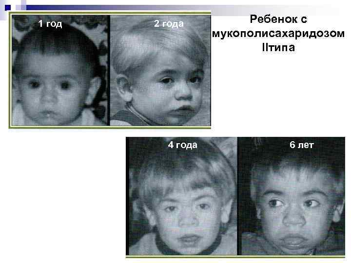 1 год 2 года 4 года Ребенок с мукополисахаридозом IIтипа 6 лет 