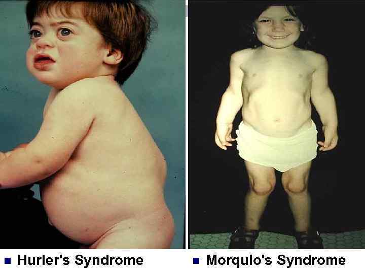 n Hurler's Syndrome n Morquio's Syndrome 