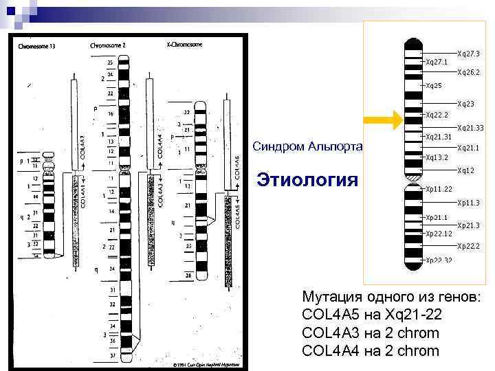 Синдром Альпорта Этиология Мутация одного из генов: COL 4 A 5 на Xq 21