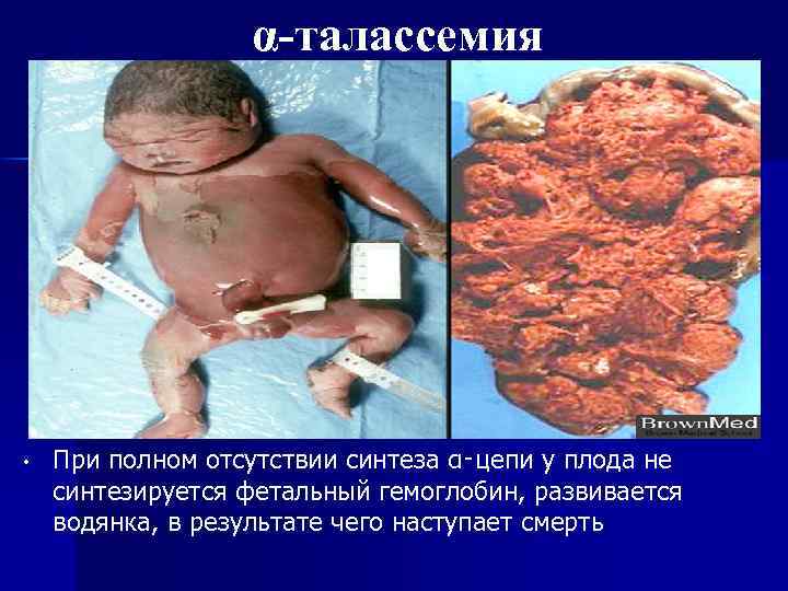 α‑талассемия • При полном отсутствии синтеза α‑цепи у плода не синтезируется фетальный гемоглобин, развивается