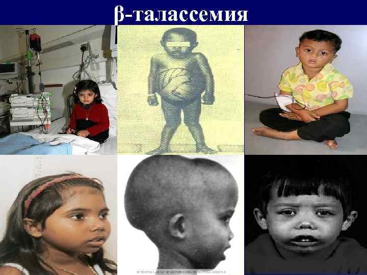 β‑талассемия 