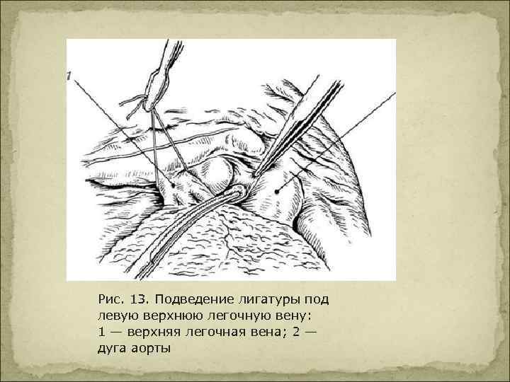 Рис. 13. Подведение лигатуры под левую верхнюю легочную вену: 1 — верхняя легочная вена;