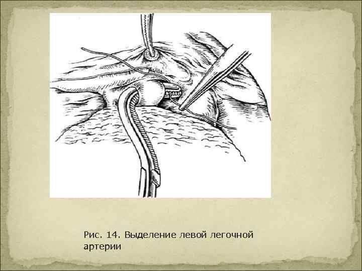 Рис. 14. Выделение левой легочной артерии 
