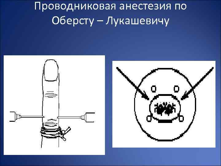 Проводниковая анестезия по Оберсту – Лукашевичу 
